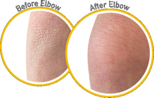 Skin Repair - body lotion - før og efter billede